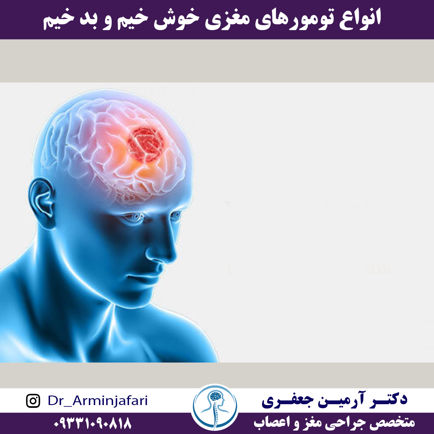 انواع تومور های مغزی- خوش خیم و بدخیم