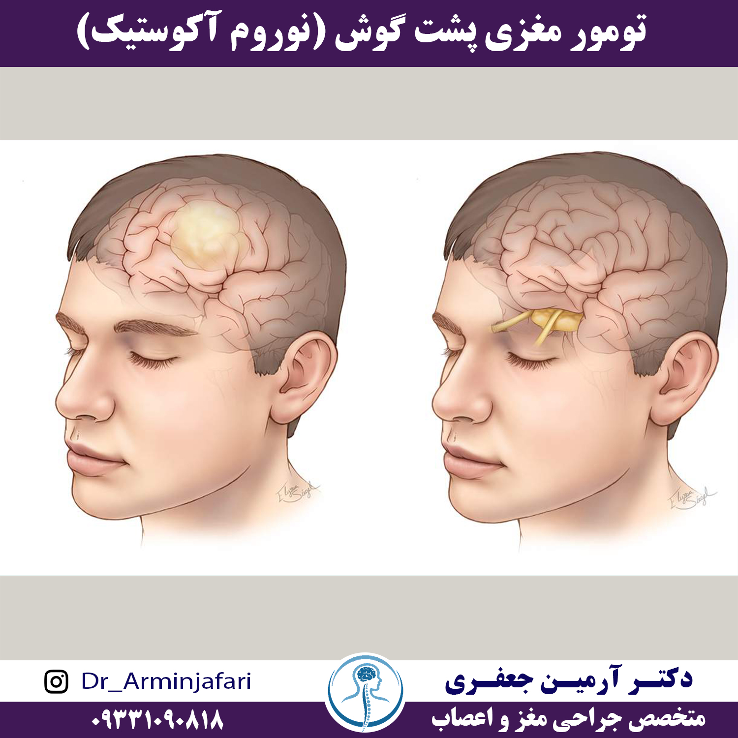 نوروم آکوستیک یا تومور مغزی پشت گوش