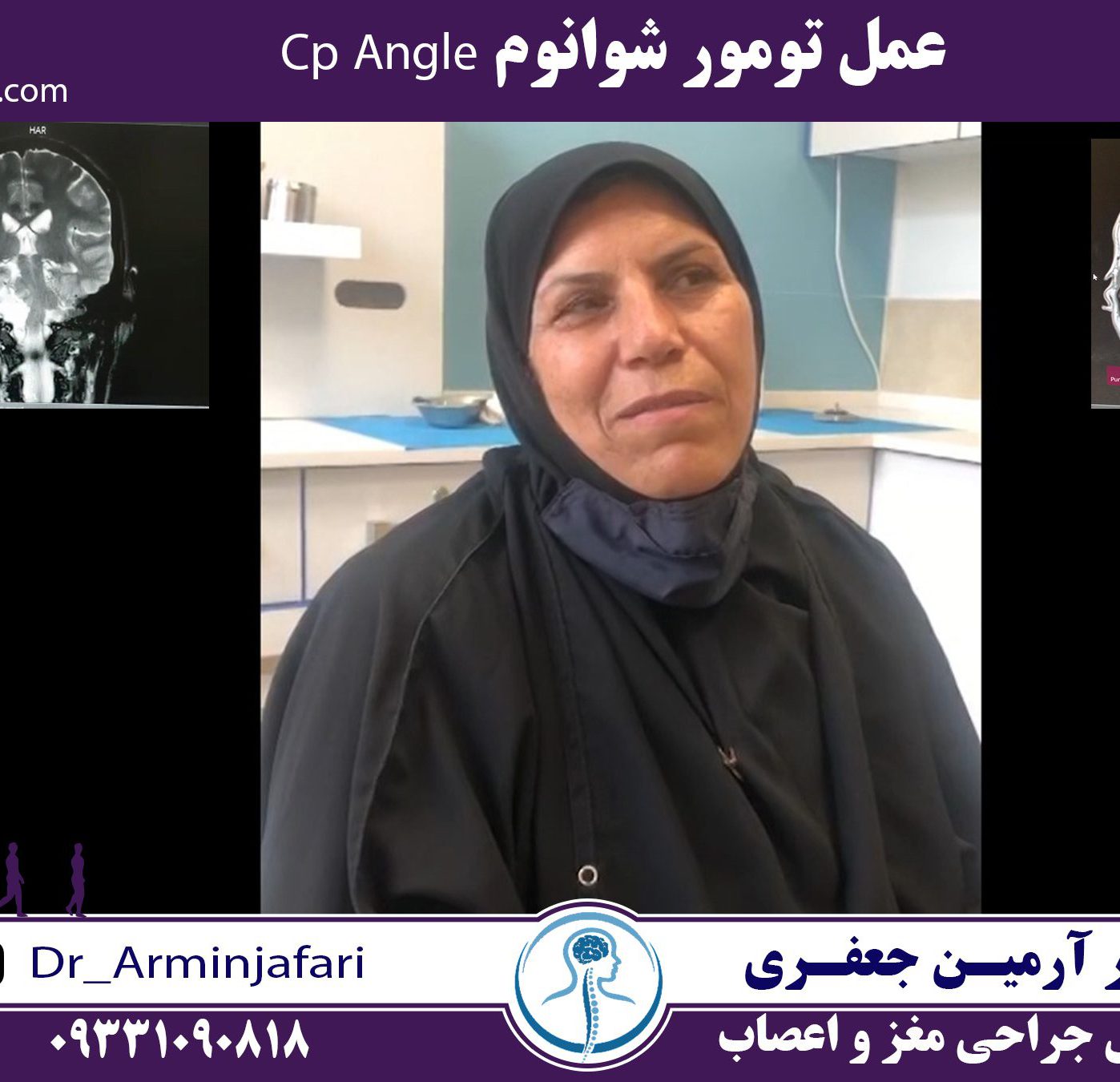 عمل تومور شوانوم Cp Angle