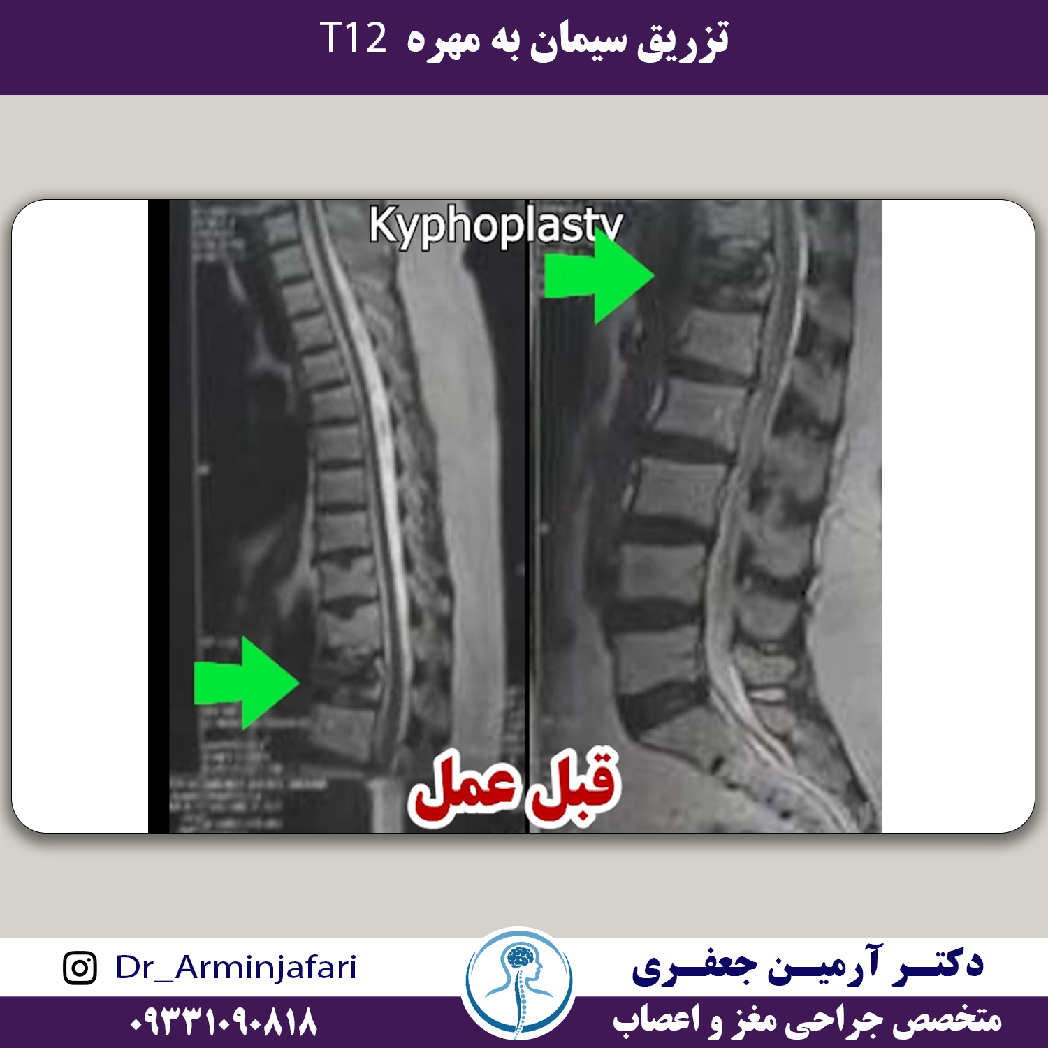 عمل جراحی تزریق سیمان (kyphoplasty)