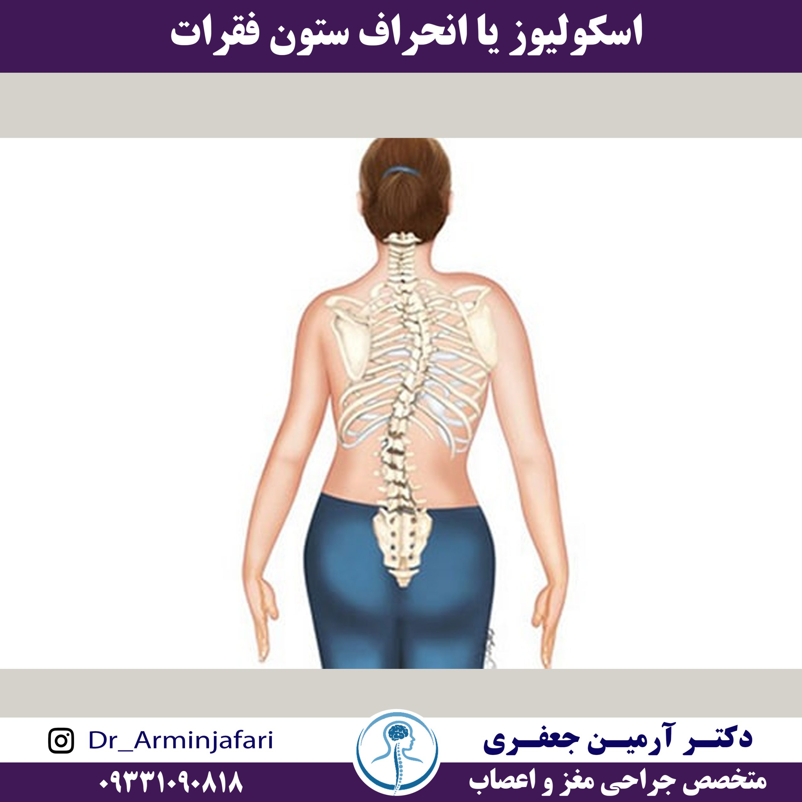 اسکولیوز یا انحراف ستون فقرات