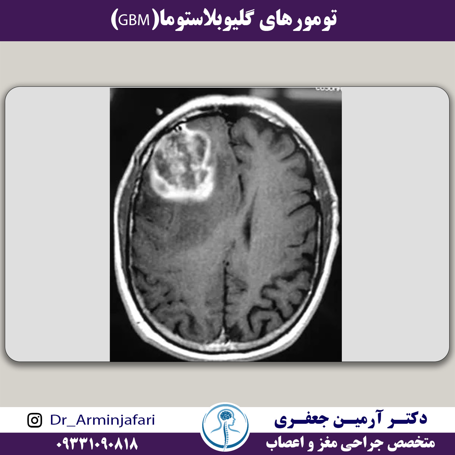 تومورهای گلیوبلاستوما