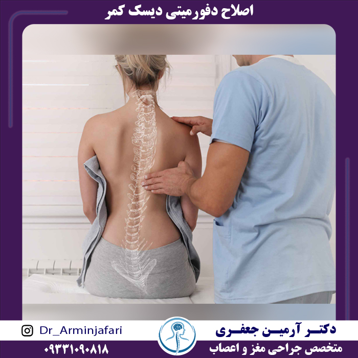 اصلاح دفورمیتی دیسک کمر